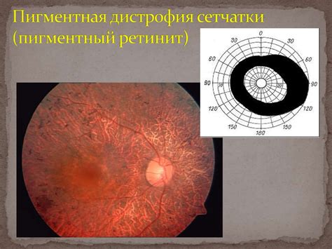 Патология сетчатки и зрительного нерва. Изменения органа зрения при ...