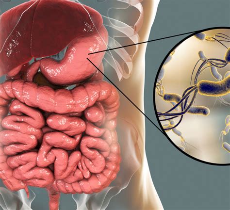 how to get rid of h pylori bacteria naturally
