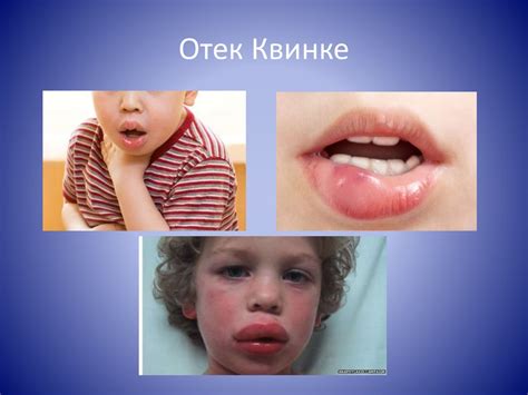 Аллергические реакции - презентация онлайн