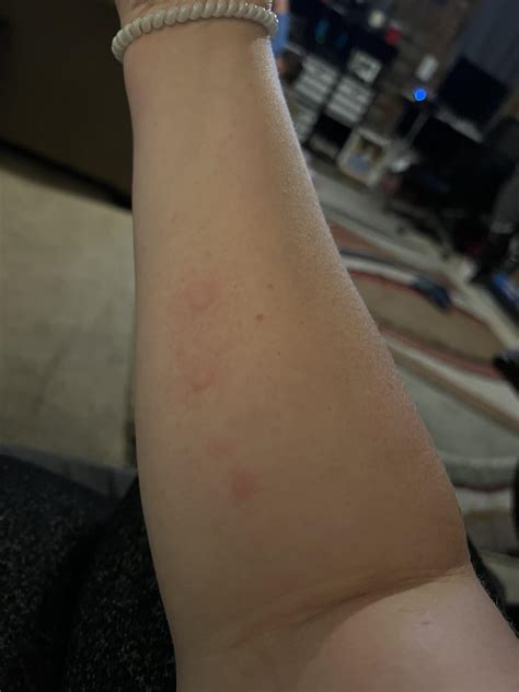 New allergic reaction while dining out - anyone else had a similar