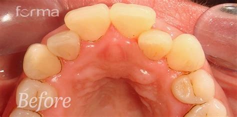 Invisalign Severe Crowding before and after gallery | Forma Smile & Beauty