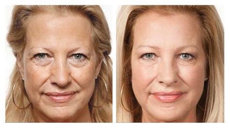 PRP Injection Before & After | Platelet Rich Plasma Reviews