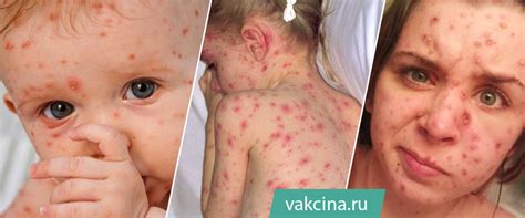 Ветрянка у взрослых и детей: как передается, симптомы и лечение ...