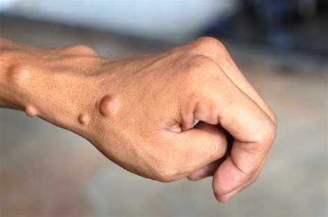 O'que É Neurofibromatose - Neurofibromatose: o que é, sintomas, tipos, causas e tratamento - Tua Saúde