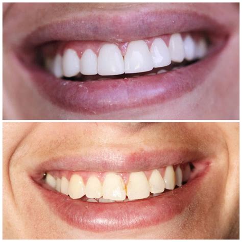 Composite Bonding in North Miami Beach l Sonrisas Dental Miami