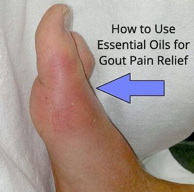 Essential Oils For Gout Pain Relief