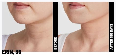Ulthera Skin Tightening | Ethemba Health and Image Centres