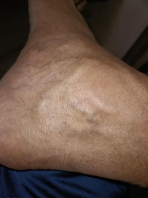 Are these vericose veins : r/varicose_veins
