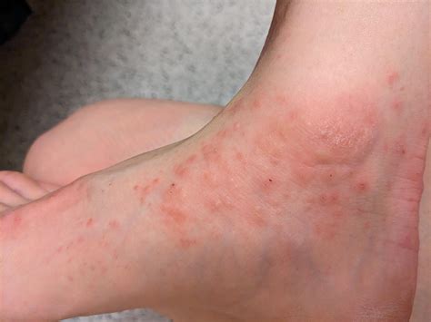 Hives or eczema? Itchy raised bumps that last for weeks : r