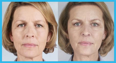 Injectable Collagen Stimulating Treatment – Saphira Clinic