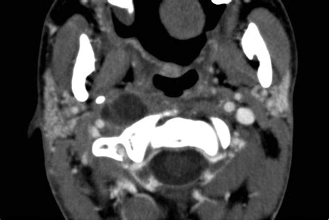 retropharyngeal adenitis axial ct scan demonstrates suppurative