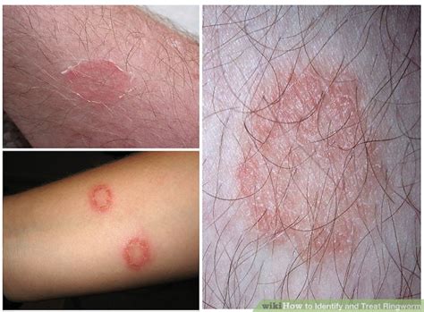 Ringworm - Symptoms, Causes, Complications And Risk Factors
