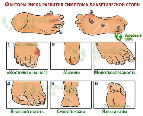 Диабетическая стопа: лечение, профилактика, симптомы, диагностика ...