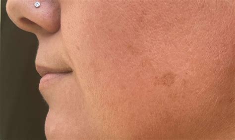 Behandla pigmentfläckar på rätt sätt – Kemikalieklok