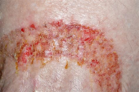 medical adhesive tape allergy  phillip dorsey blog