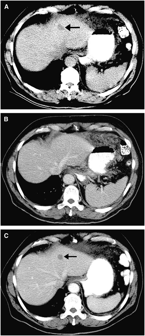 NCCN Task Force Report: Update on the Management of Patients with ...