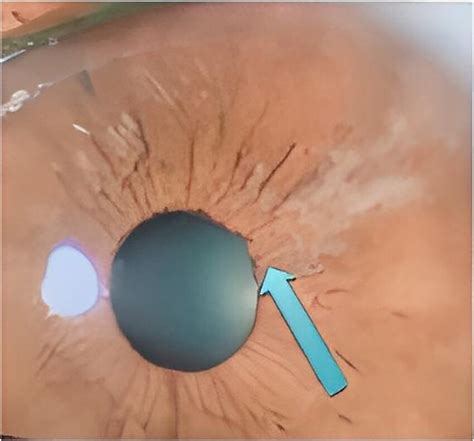 Patient's ophthalmoscopy, showing iris retraction and areas of fibrosis ...