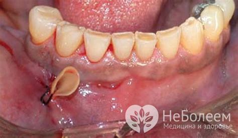 Абсцесс зуба: симптомы, лечение, причины, фото