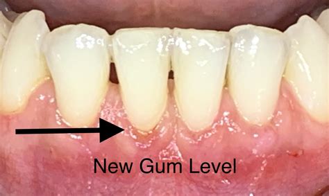 Gum Grafting - Behrens Dental