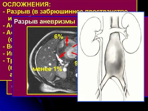Аневризмы брюшного отдела аорты - презентация онлайн
