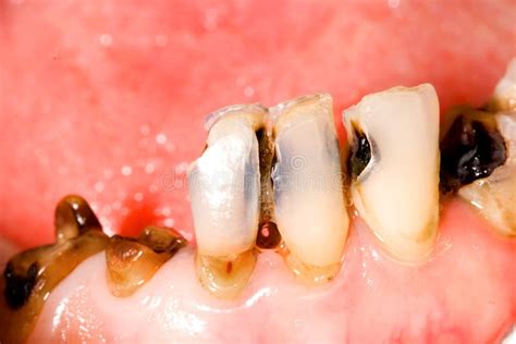 Tooth caries stock photo. Image of periodontal, decay - 28859026