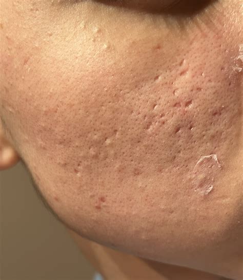 Treatment for Acne Scars and Severity – Scar treatments – Acne.org Forum
