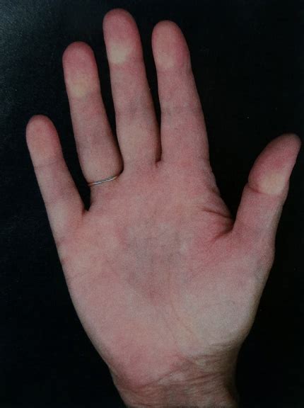 Beadlust: I have Dupuytren’s Disease