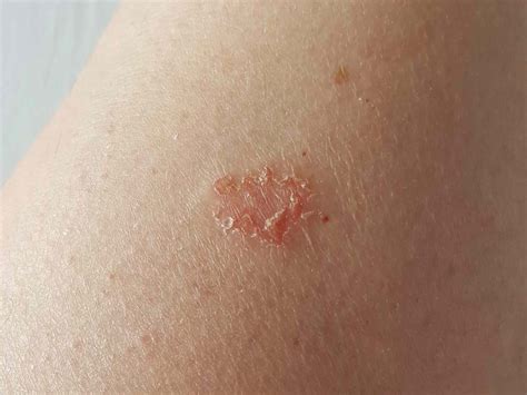Discoid Eczema: Symptoms, Causes, Diagnosis, Treatment, and Coping