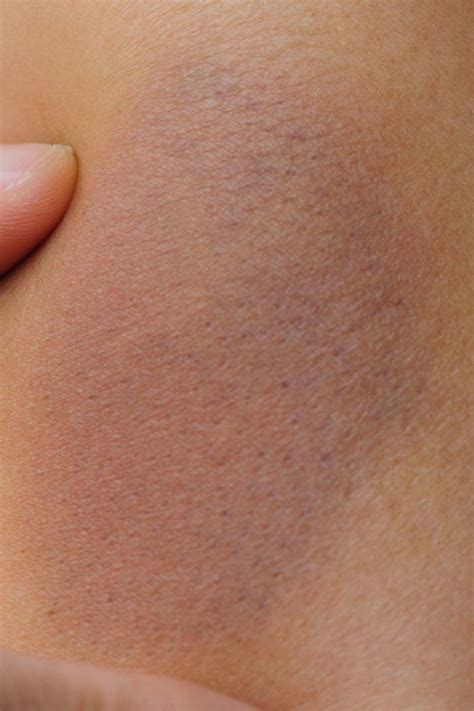 bruise colors stages     contact  doctor