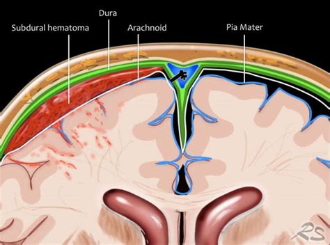 Difference Between Subdural And Epidural