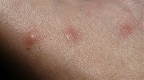 Allergic Reaction to Spider Bites - Spider Bite Treatment
