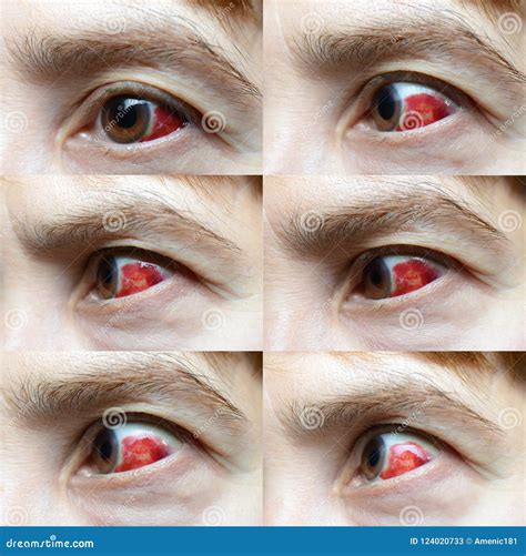 blood vessels in face burst 5