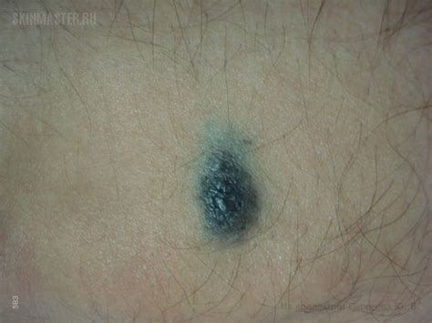 Голубой невус. Случай №285 из дерматологического атласа профессора Ю.В ...