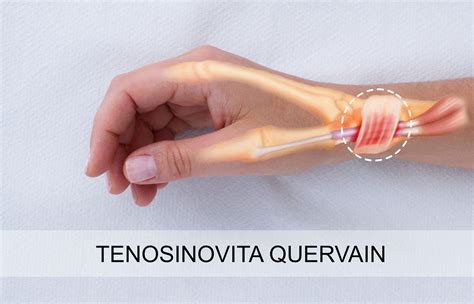 Tenosinovita Quervain | Chirurg Ortoped Doctor Mitrulescu