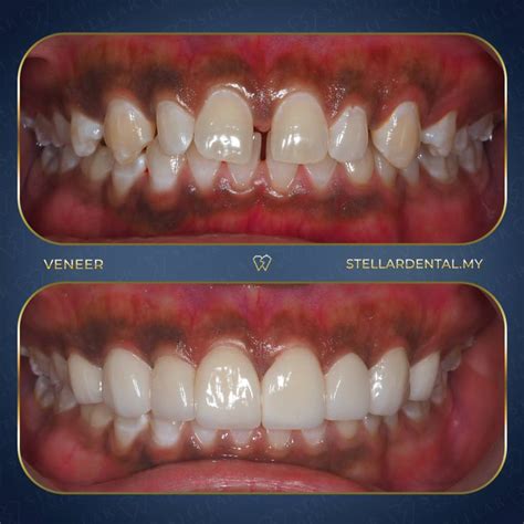 Everything You Need to Know About Teeth Veneers - Stellar Dental