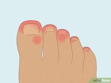 Trench Foot