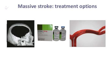 Massive Stroke by Dr Candice Delcourt