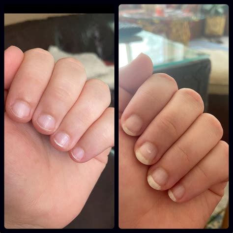 how to stop biting your nails 8