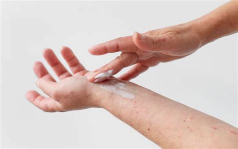 punya eksim intip   mengelolanya  tak  kambuh okezone