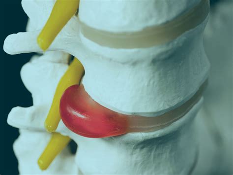 Effective Treatments For Slipped disc | Osteopathy Clinic | London