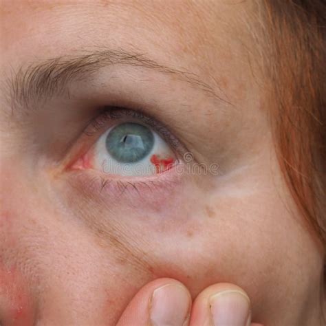 Subconjunctival Hemorrhage or Subconjunctival Bleeding, Hyposhagmus ...