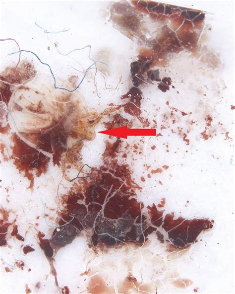 What to do about Imaginary Insect or Mite Infestations | Published in