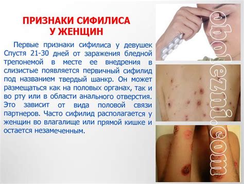 Пин от пользователя Гид по Здоровью на доске Сифилис - симтомы у женщин ...
