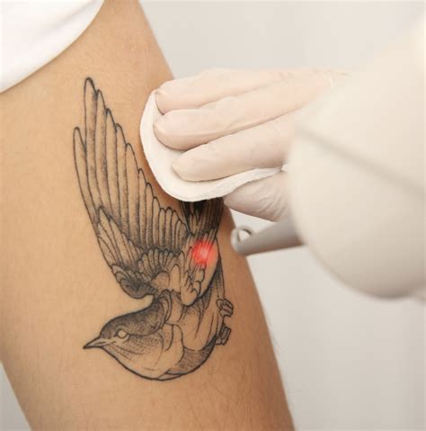 Laser Tattoo Removal - Derma Revive Skin Clinic