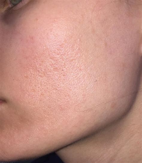 [Routine Help] Suggestions for repairing minimal scarring before
