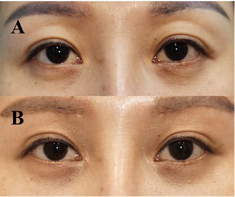 (A) Preoperative, bilateral moderate upper eyelid depression and skin ...