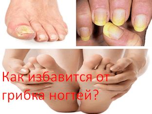 Лечение грибка ногтей в домашних условиях самыми быстрыми способами