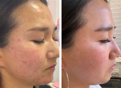 Laser Facial | MBAR | Honolulu, Hawaii, Oahu