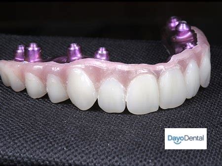 Denture Implants vs Fixed Bridge - Teeth Replacement Options - False teeth