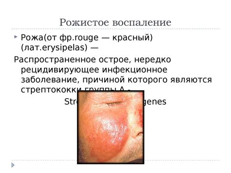 Рожистое воспаление - презентация онлайн